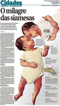 O Correio contou a história das gêmeas com exclusividade em 29 de abril. As bebês, à época com 10 meses, passaram por cirurgia inédita na capital. O procedimento durou mais de 20 horas e 50 profissionais participaram 