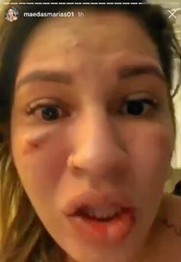 Com rosto ferido, Milena publicou vídeo em que denuncia o goleiro Jean (Fotos: Reprodução/Video
)